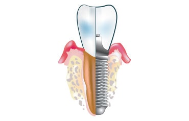 Dentalni implantati