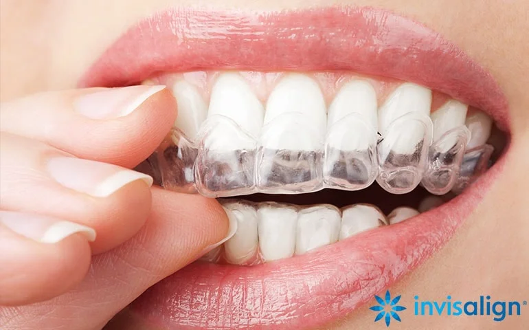 invisalign