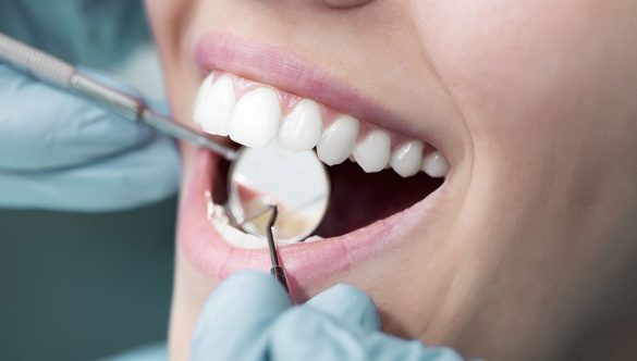 Čisti zub ne može oboljeti niti dobiti karijes.